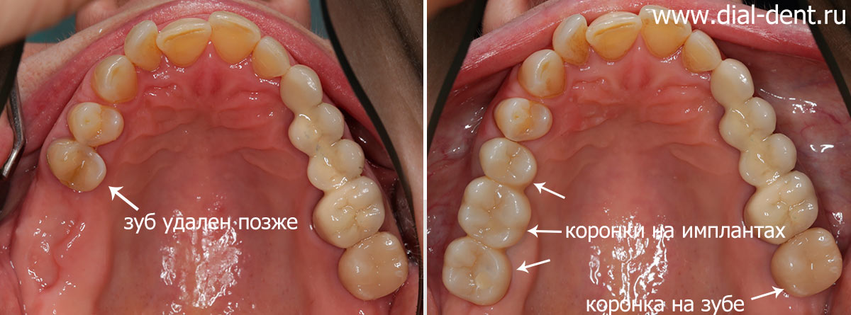 верхние зубы до и после протезирования