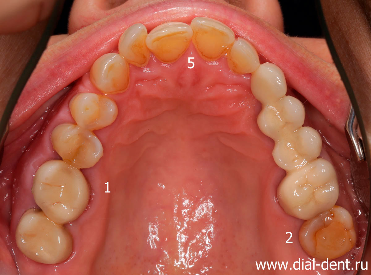 верхние зубы до лечения