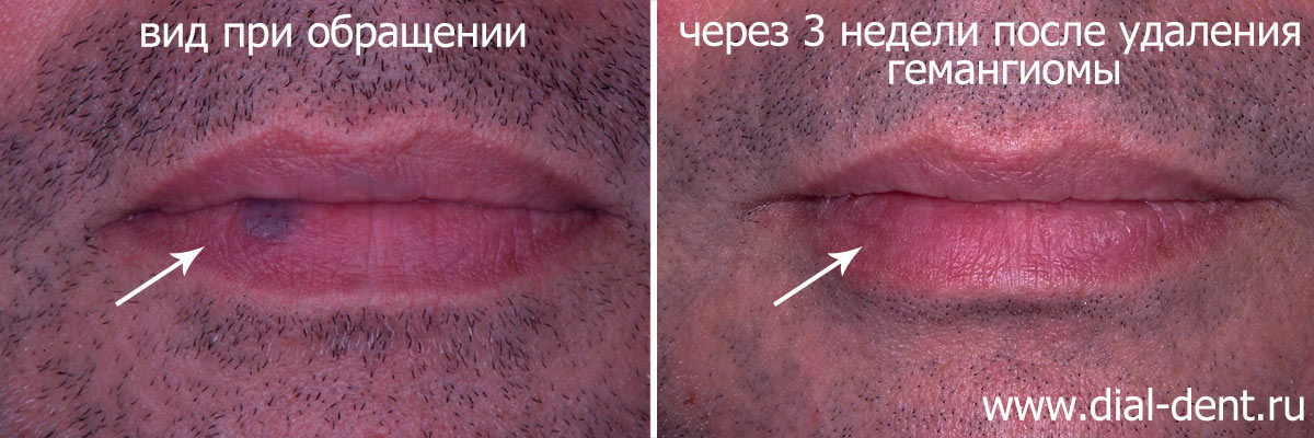 до и после лечения гемангиомы на губе у взрослого пациента