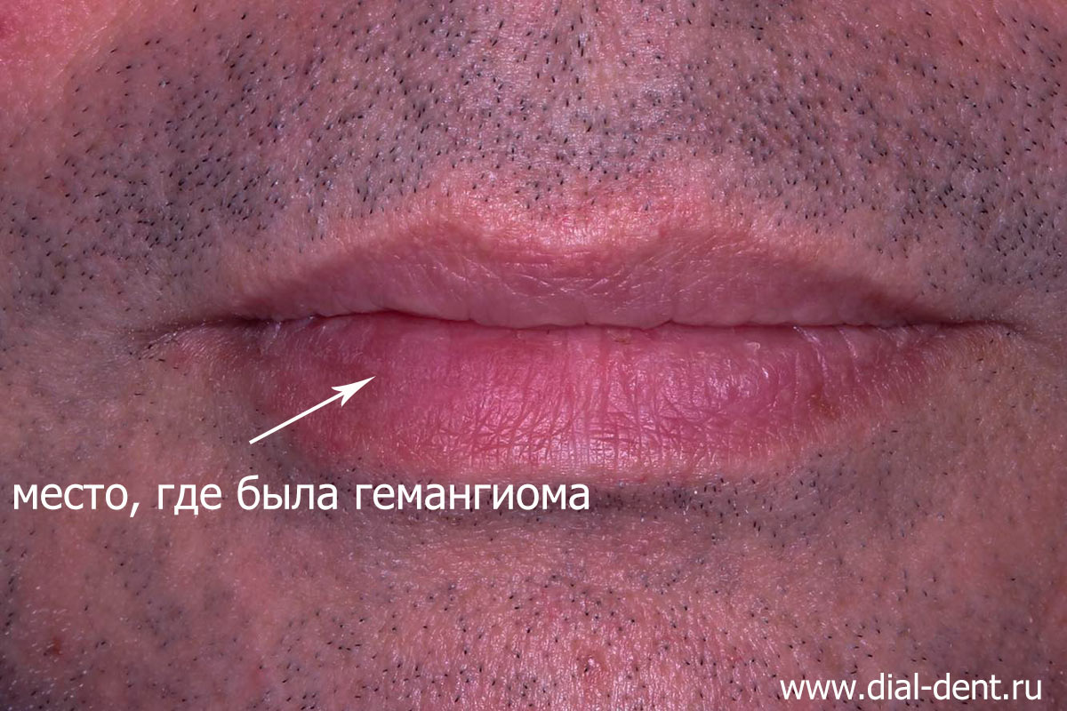 после удаления гемангиомы на губе методом склерозирования