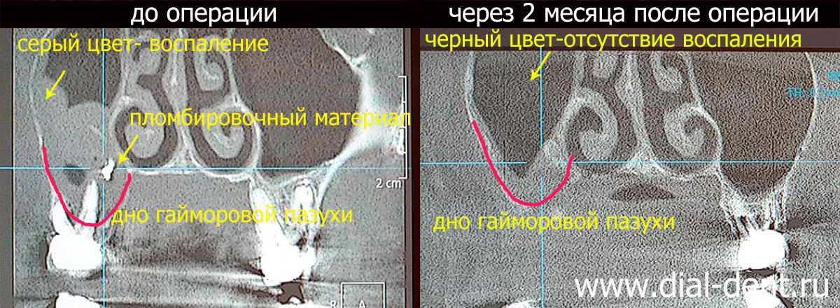 операция на гайморовой пазухе - удаление мицетомы (до и после операции)
