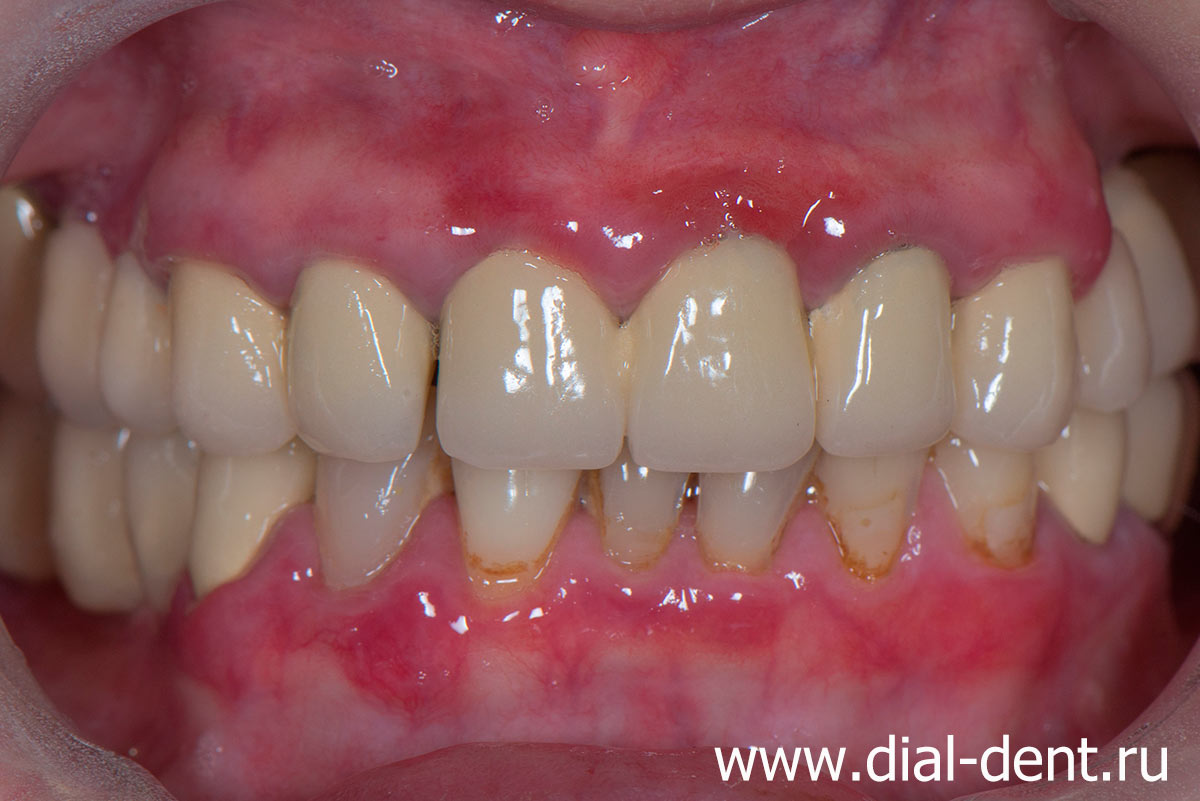 вид зубов до лечения - старые коронки на передних зубах, мостовидные протезы боковых зубов