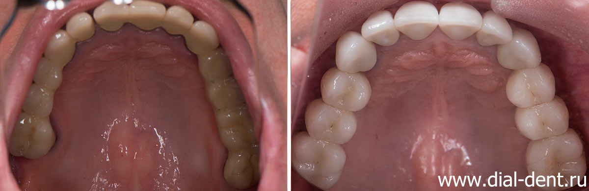 верхние зубы до и после протезирования керамикой