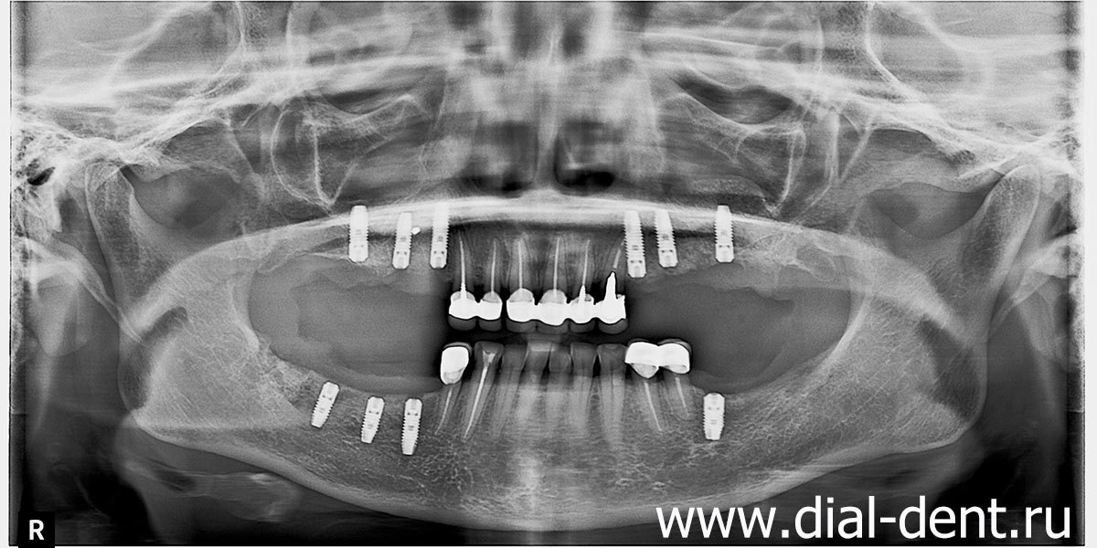 панорамный снимок после установки зубных имплантов и их приживления