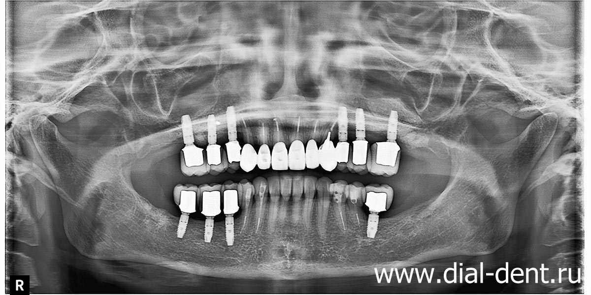 панорамный снимок после имплантации и протезирования зубов керамикой