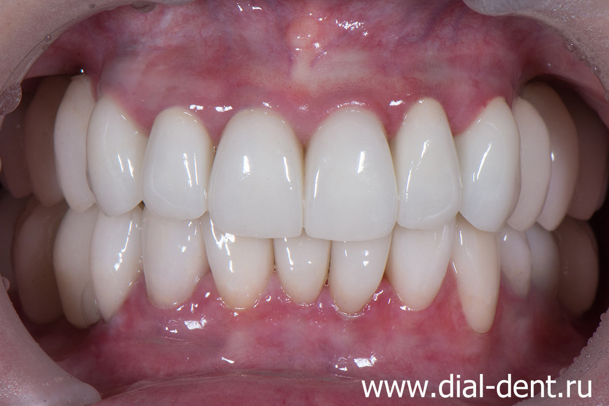 протезирование зубов керамиикой, в том числе протезирование зубов на имплантах