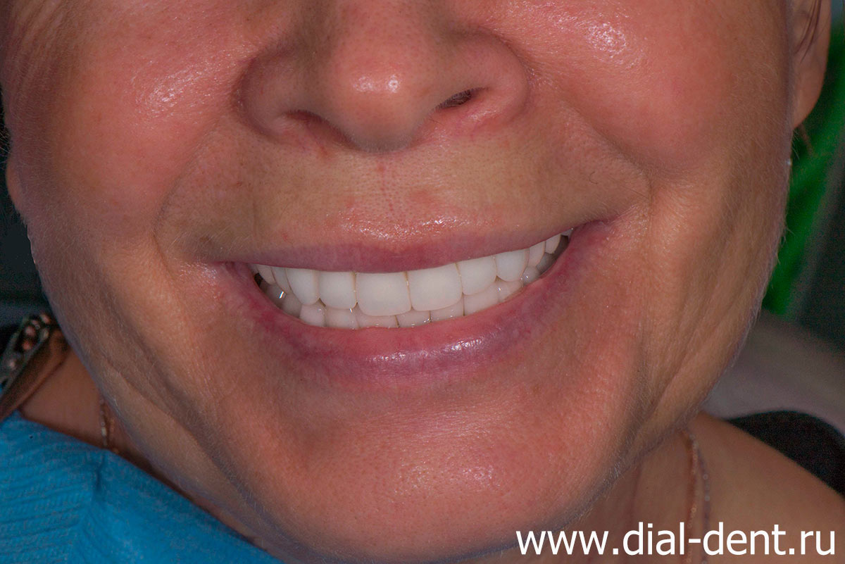 улыбка после протезирования зубов керамикой