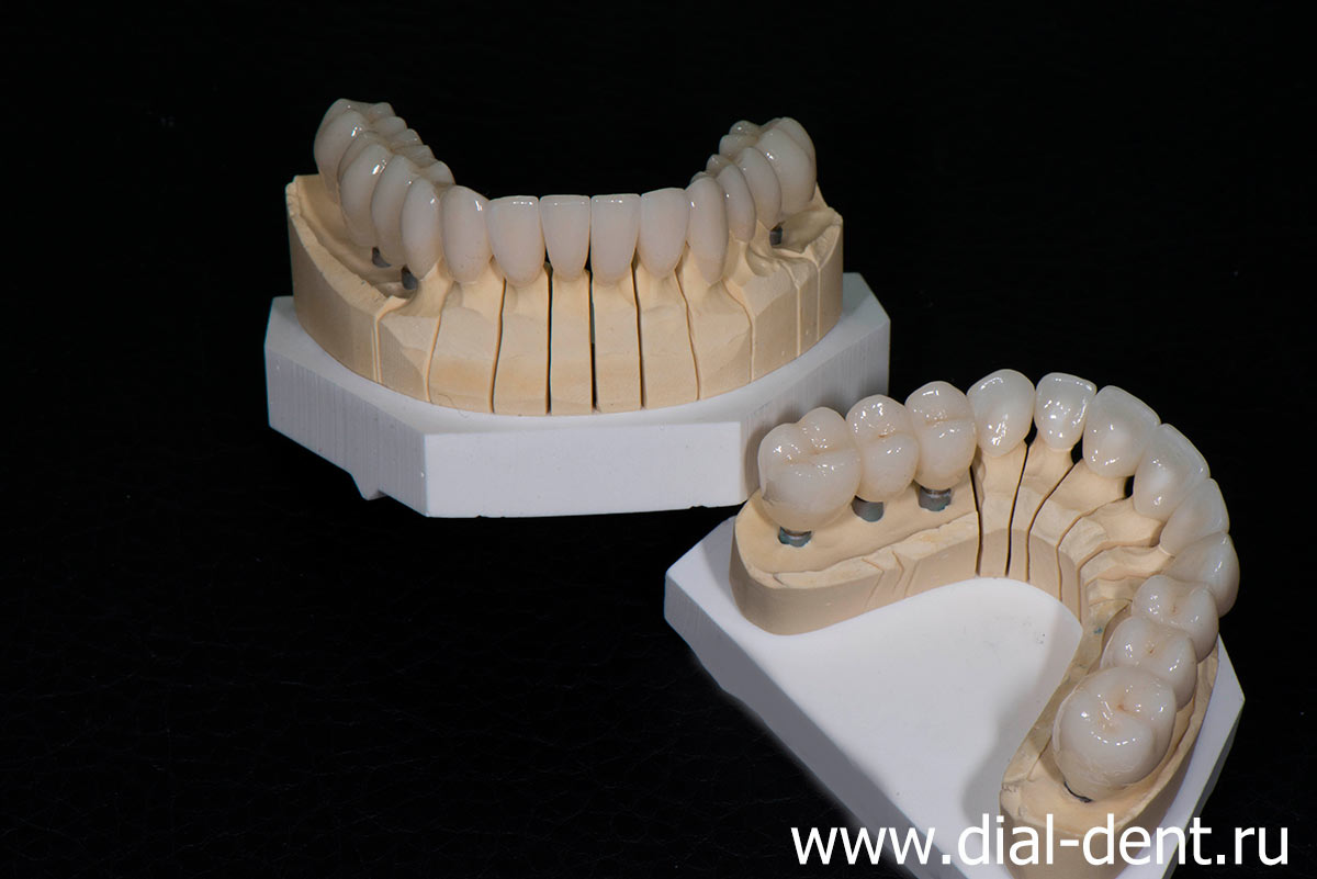 керамические коронки на зубы