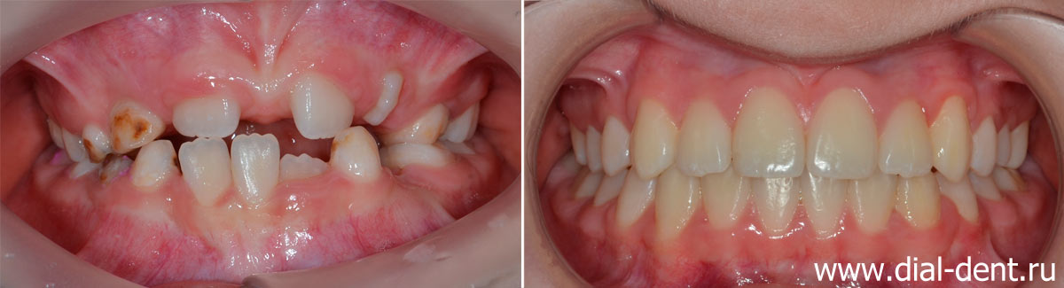 вид зубов до и после ортодонтического лечения в Диал-Дент