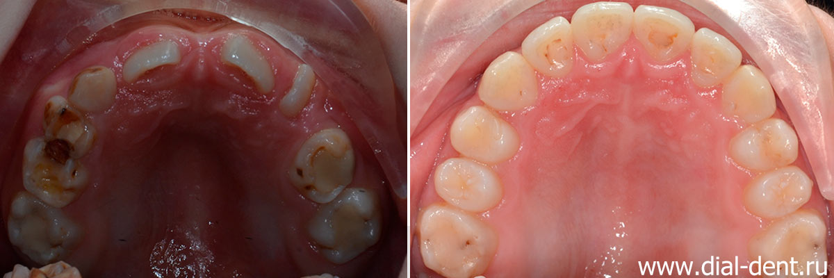 верхние зубы до и после ортодонтического лечения в Диал-Дент