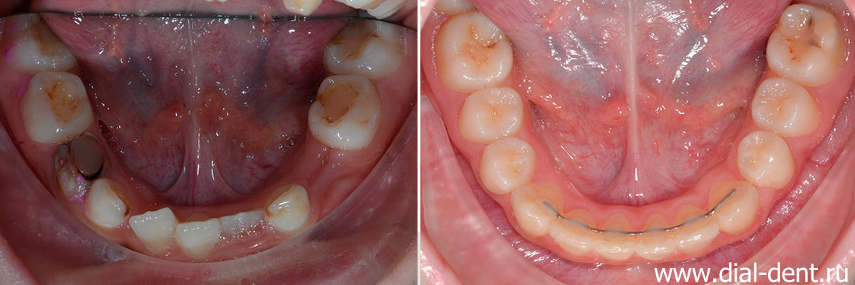 нижние зубы до и после ортодонтического лечения в Диал-Дент