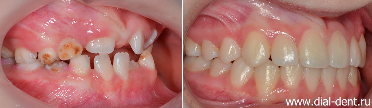 вид справа до и после ортодонтического лечения в Диал-Дент