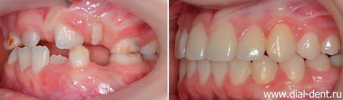 вид слева до и после ортодонтического лечения в Диал-Дент