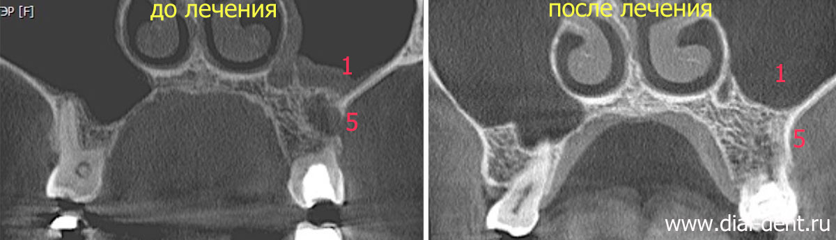 компьютерная томограмма зубов до и после лечения