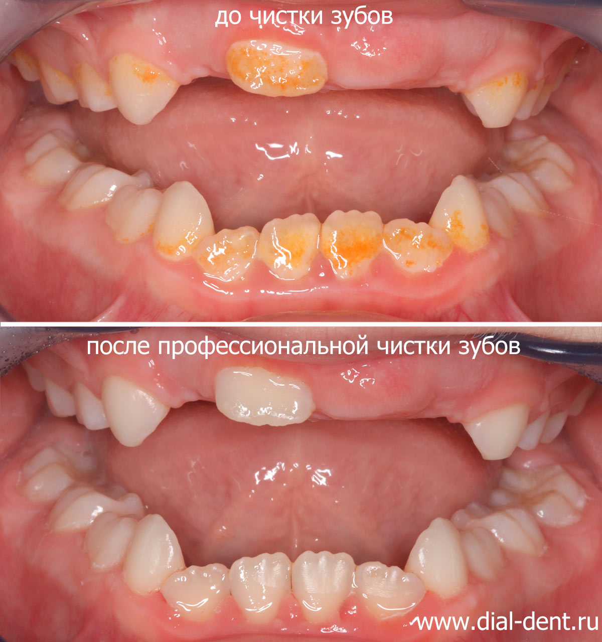 до и после профессиональной чистки зубов 
