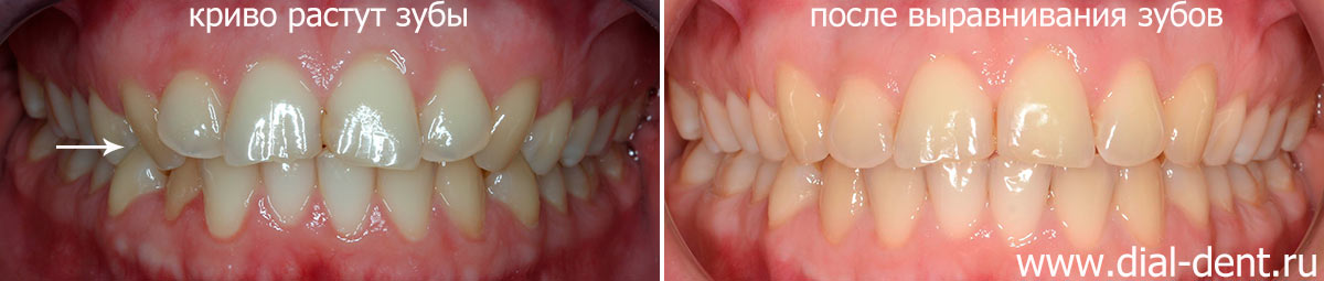 до и после выравнивания зубов брекетами