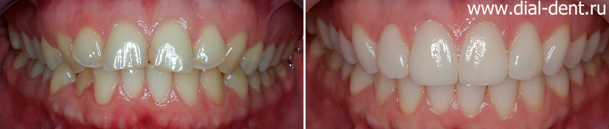 вид зубов до и после лечения и реставрации зубов