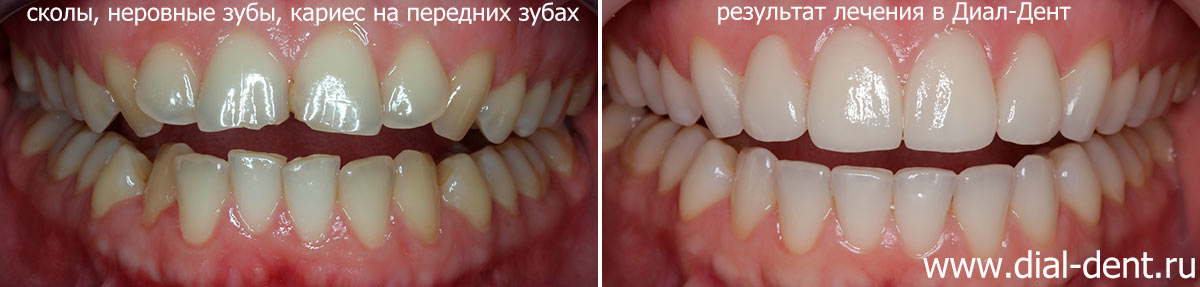 вид зубов до лечения и после лечения и реставрации