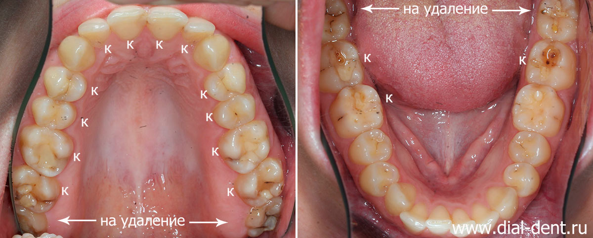 вид зубов до лечения, отмечены зубы, где надо лечить кариес