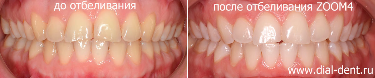 до и после отбеливания зубов 