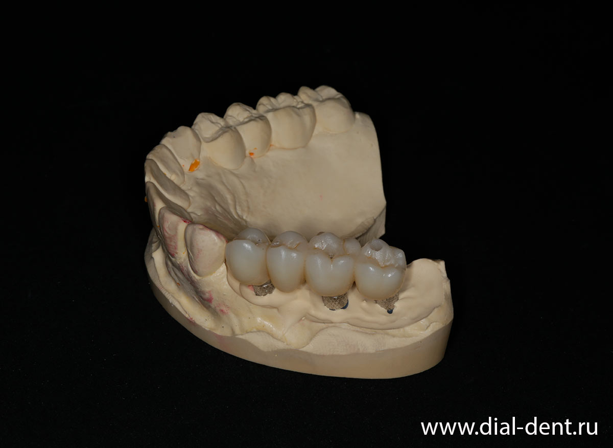 мостовидный протез из оксида циркония KATANA на модели зубов