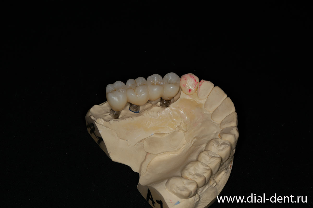 мостовидный протез из оксида циркония KATANA на модели зубов