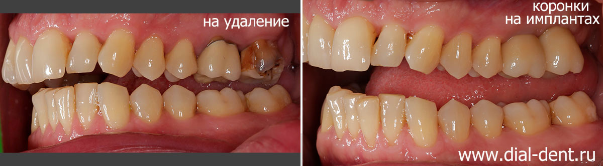 до и после удаления зубов и протезирования на имплантах