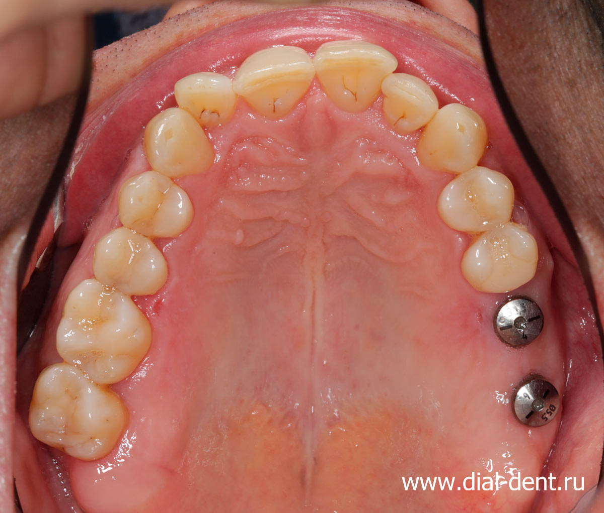 зубные импланты Astra Tech с формирователями десны