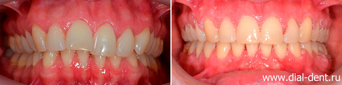 вид зубов до и после исправления прикуса