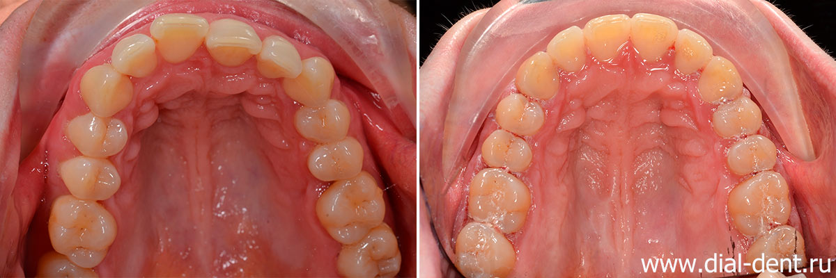 верхние зубы до и после исправления прикуса