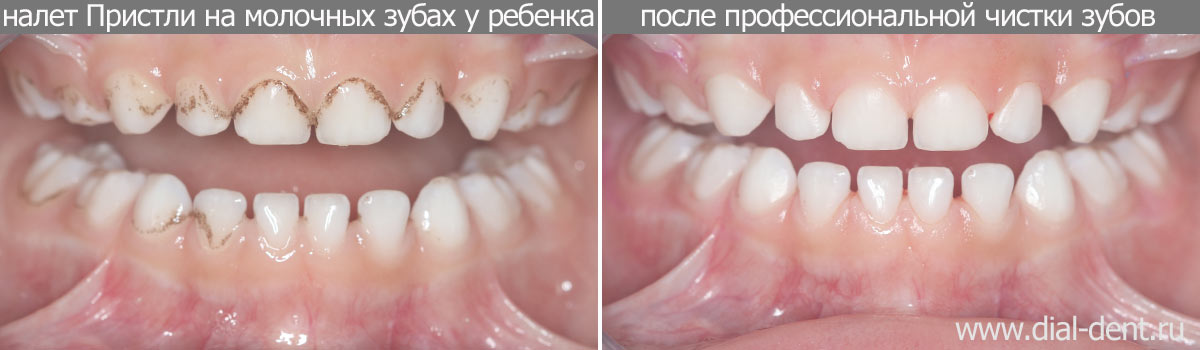 фото налет Пристли до и после чистки зубов