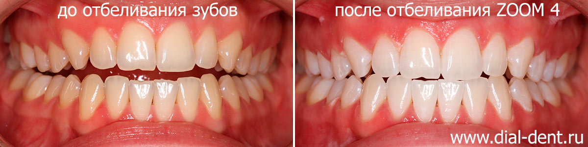 вид зубов до и после отбеливания ZOOM 4