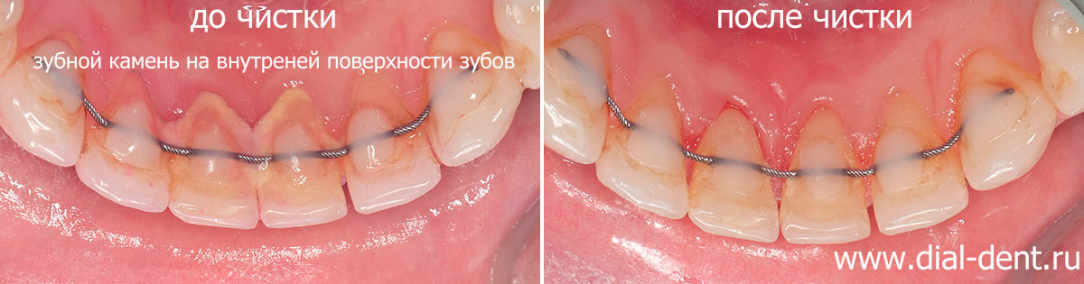 чистка зубов с ретейнером - удаление налета и зубного камня