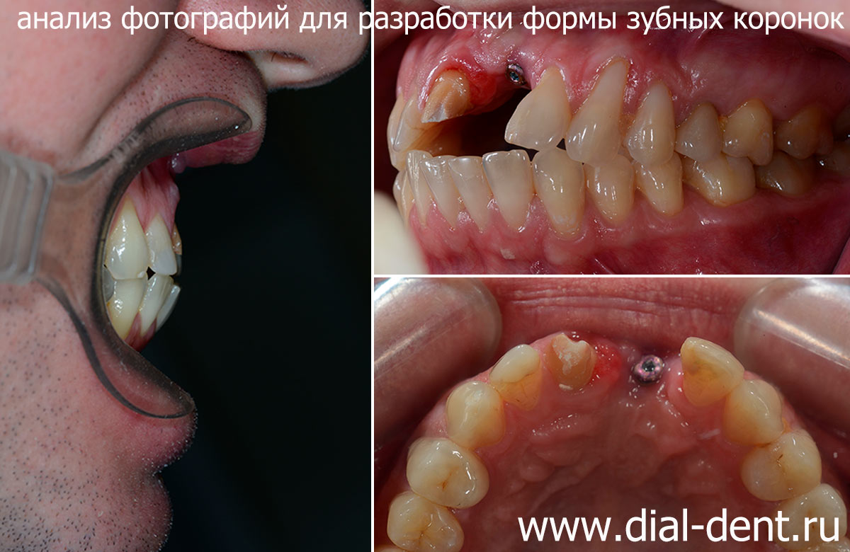 подготовка к протезированию зубов - анализ фотографий с разных ракурсов