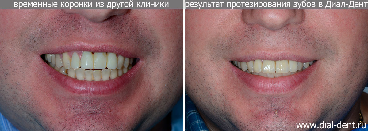 исправление чужих ошибок протезирования зубов