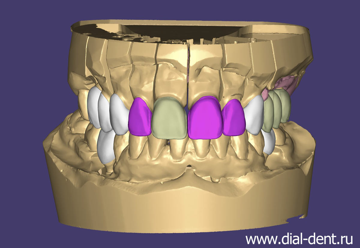 трехмерное компьютерное моделирование зубных коронок