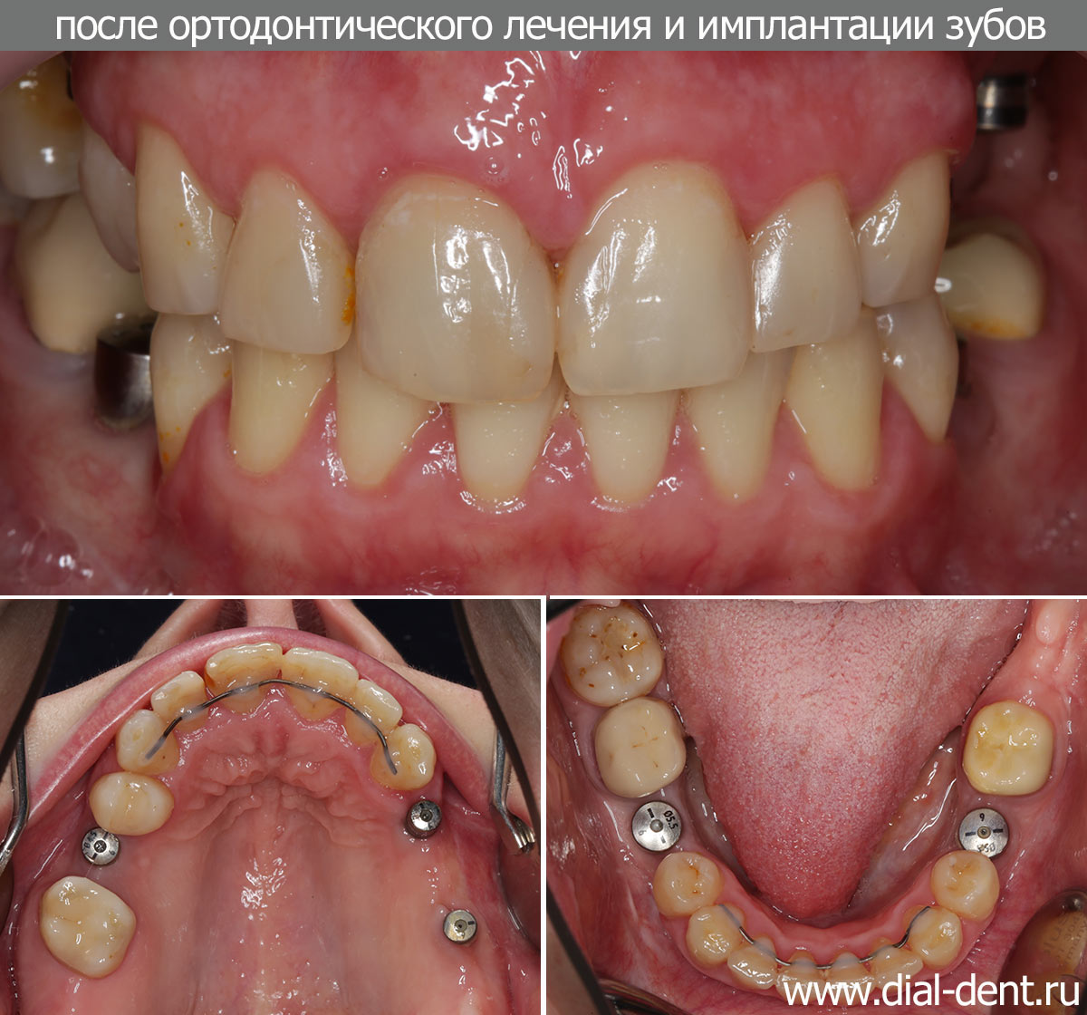 вид зубов после снятия брекетов и имплантации