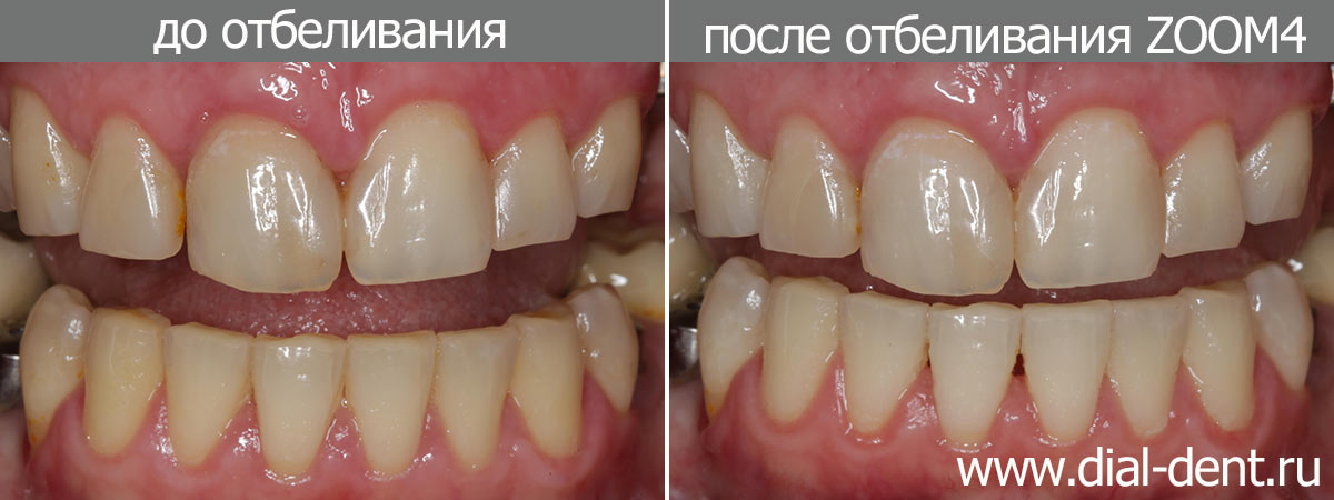 до и после отбеливания зубов ZOOM4
