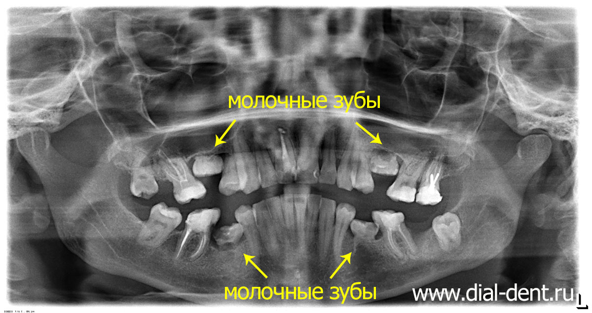 молочные зубы у взрослой пациентки