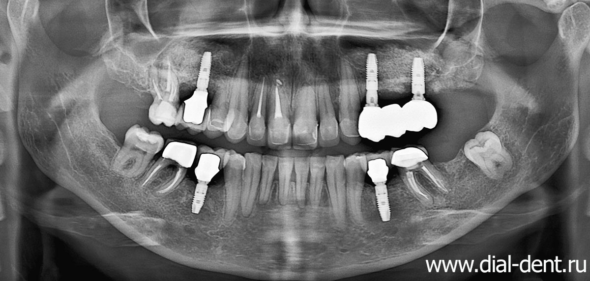 панорамный снимок зубов после комплексного лечения