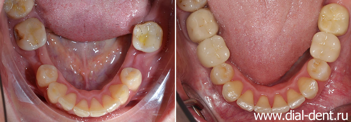нижние зубы до и после комплексного лечения в Диал-Дент