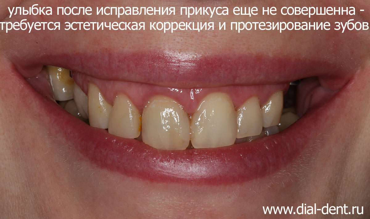 улыбка после ортодонтического лечения