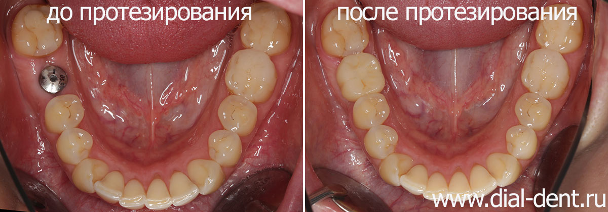 до и после протезирования отсутствующего зуба