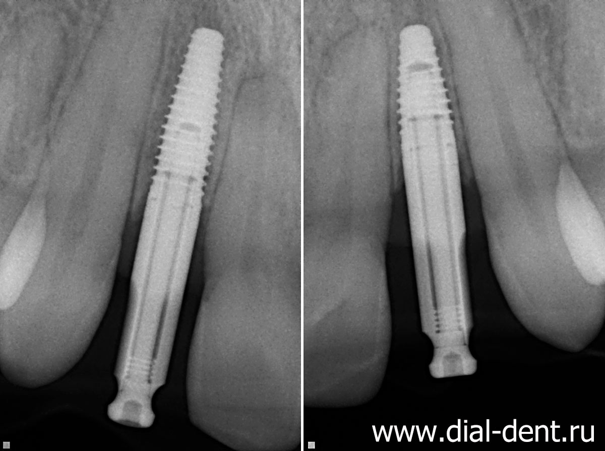 импланты при отсутствии зубов