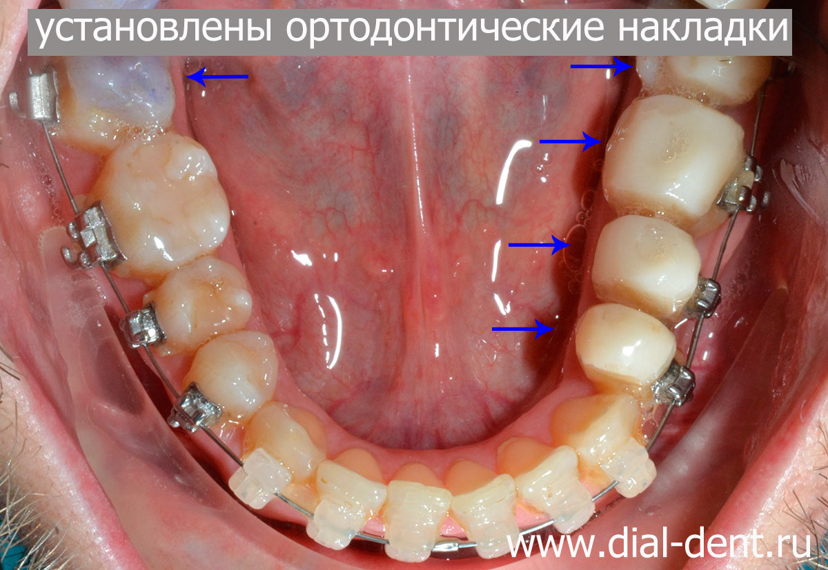 ортодонтическое лечение - применение ортонакладок