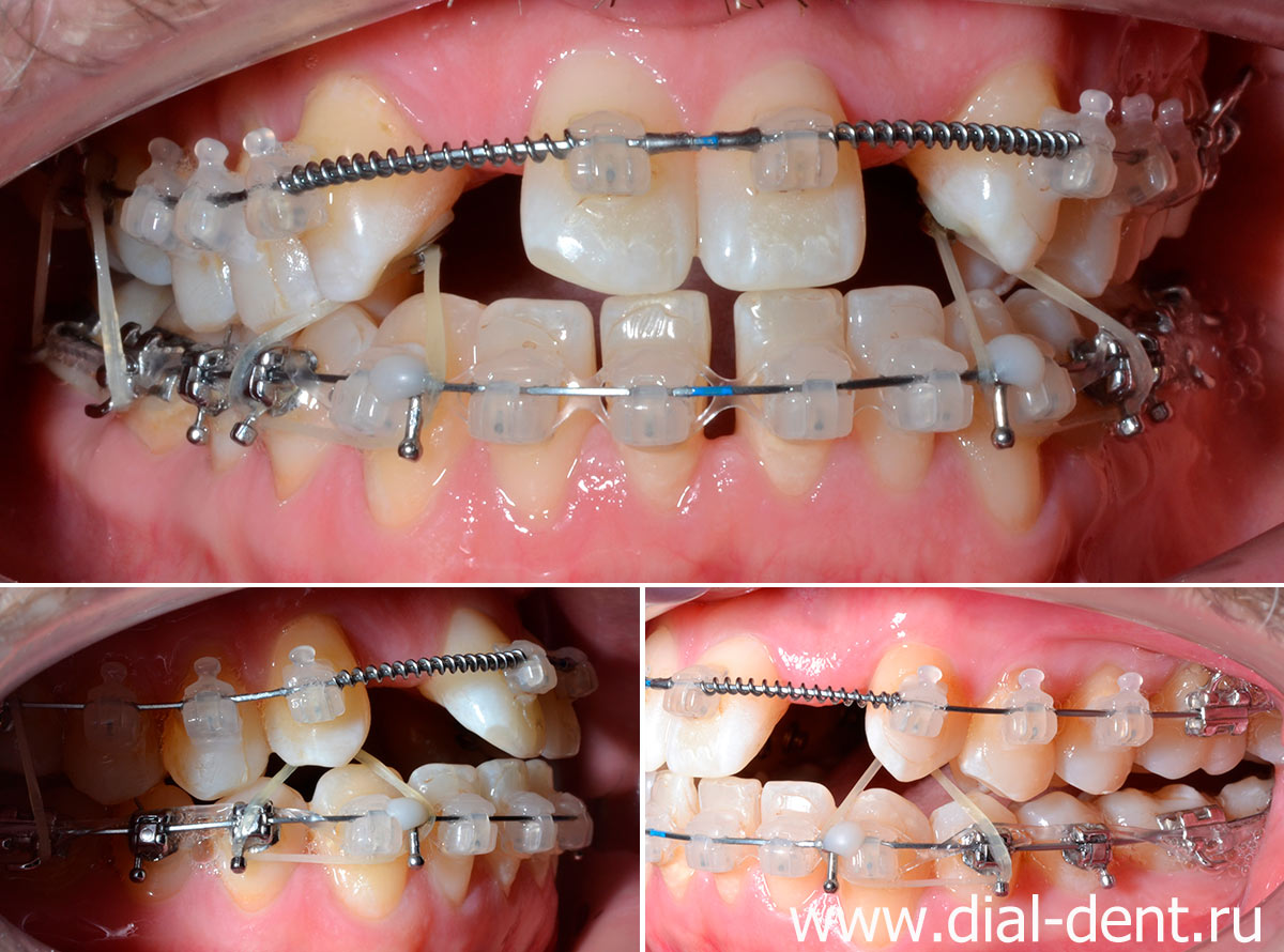 ортодонтическое лечение - применение ортодонтических эластиков
