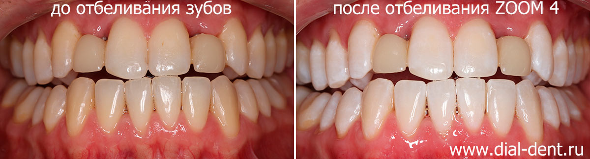 отбеливание зубов ZOOM 4