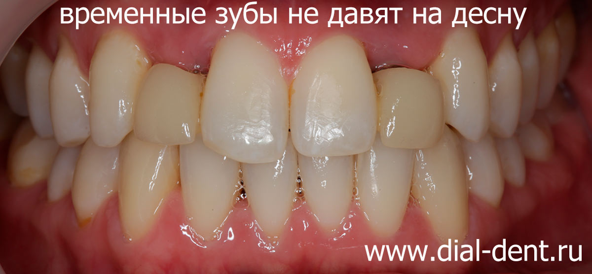 временные зубы на период приживления имплантов