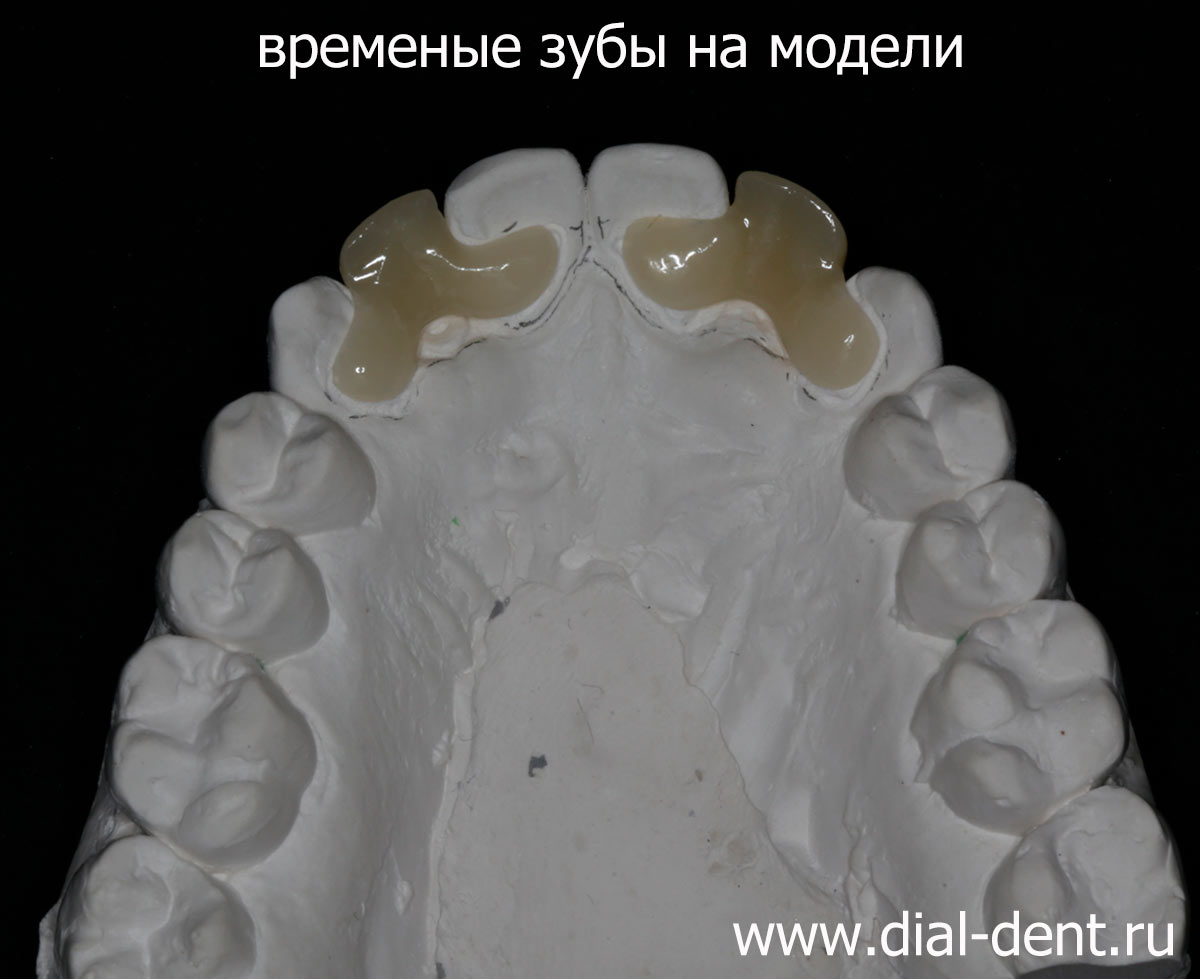 временные зубы на модели в лаборатории