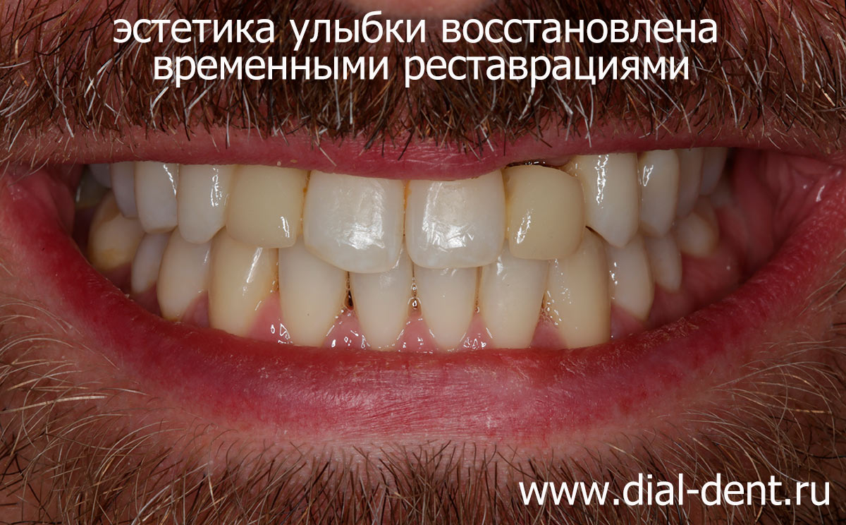 временные зубы на период приживления имплантов